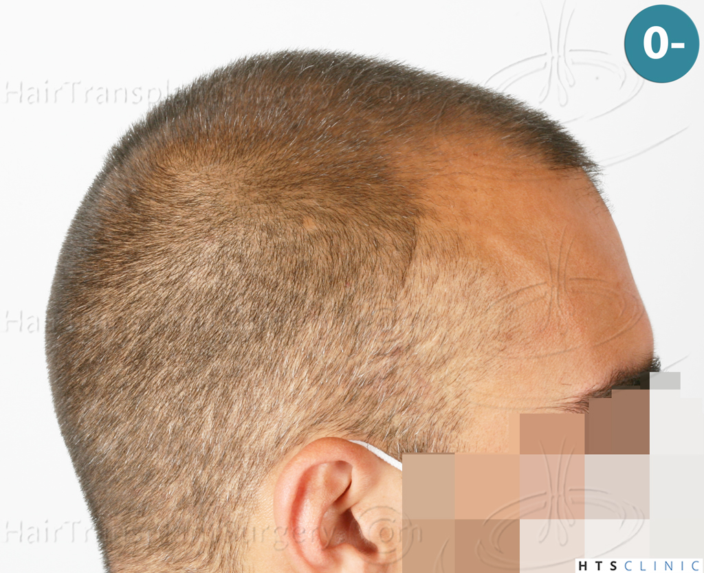 Dr.Devroye-HTS-Clinic-2258-FUE-5