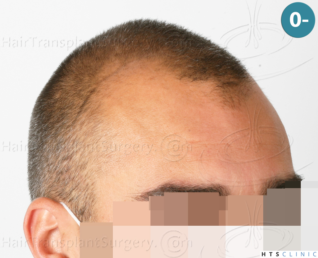 Dr.Devroye-HTS-Clinic-2258-FUE-6