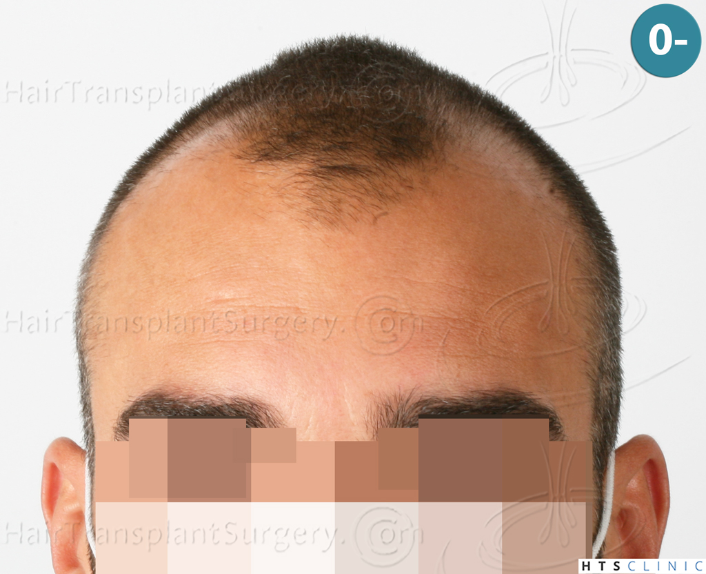 Dr.Devroye-HTS-Clinic-2258-FUE-1