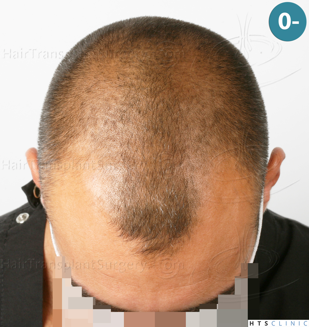 Dr.Devroye-HTS-Clinic-2258-FUE-2