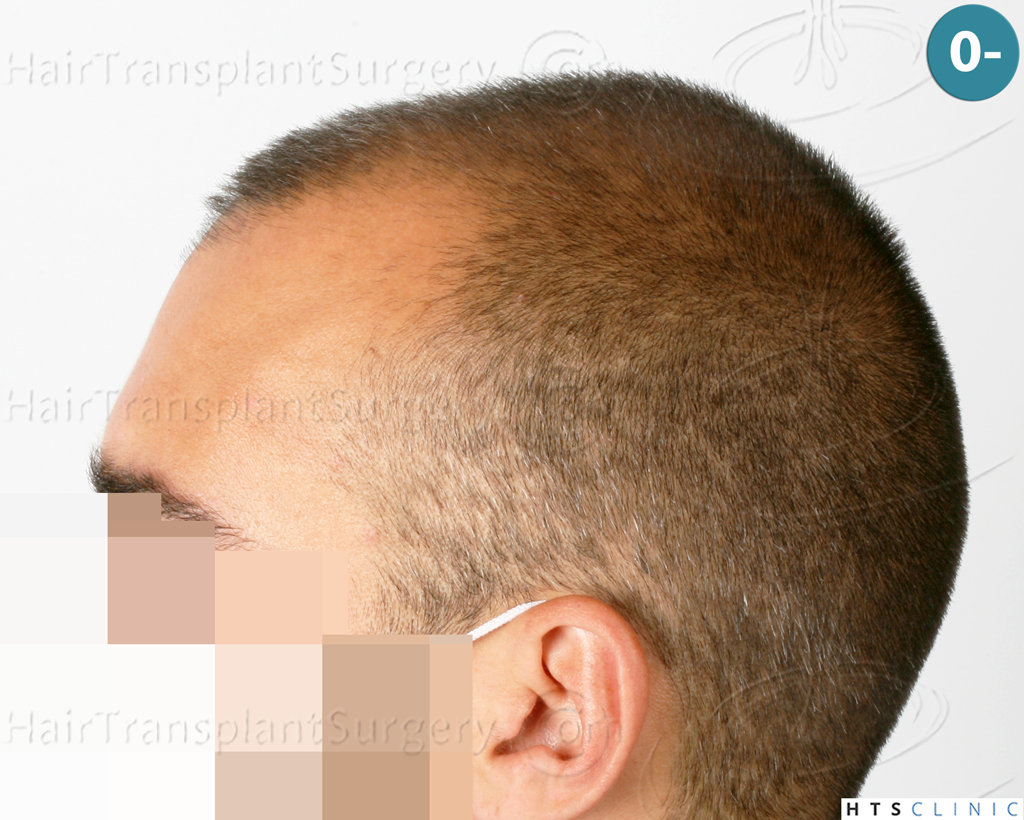 Dr.Devroye-HTS-Clinic-2258-FUE-3