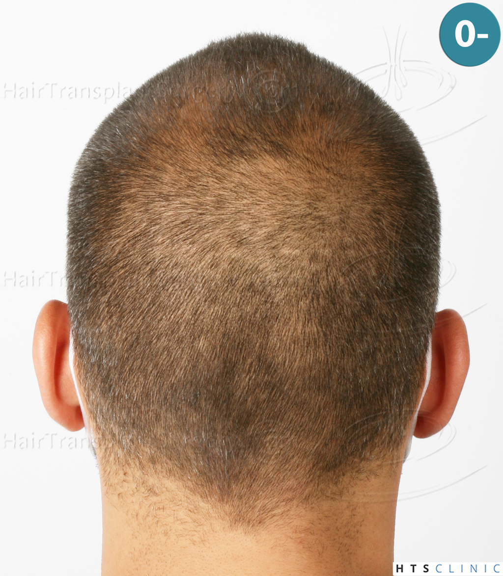 Dr.Devroye-HTS-Clinic-2258-FUE-7