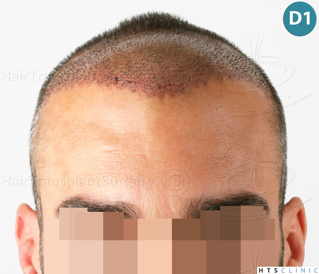 Dr.Devroye-HTS-Clinic-2258-FUE-10