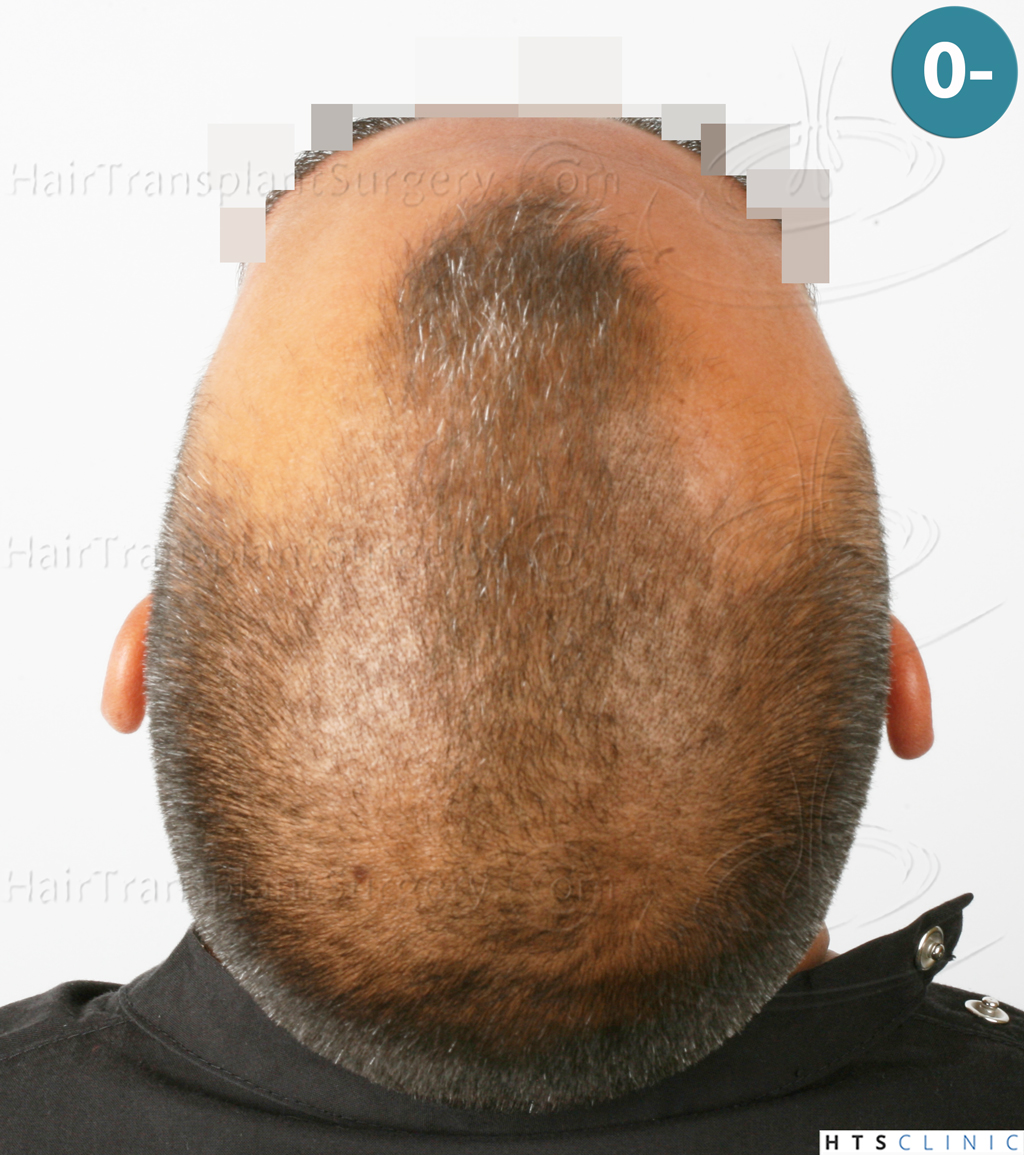 Dr.Devroye-HTS-Clinic-2258-FUE-8