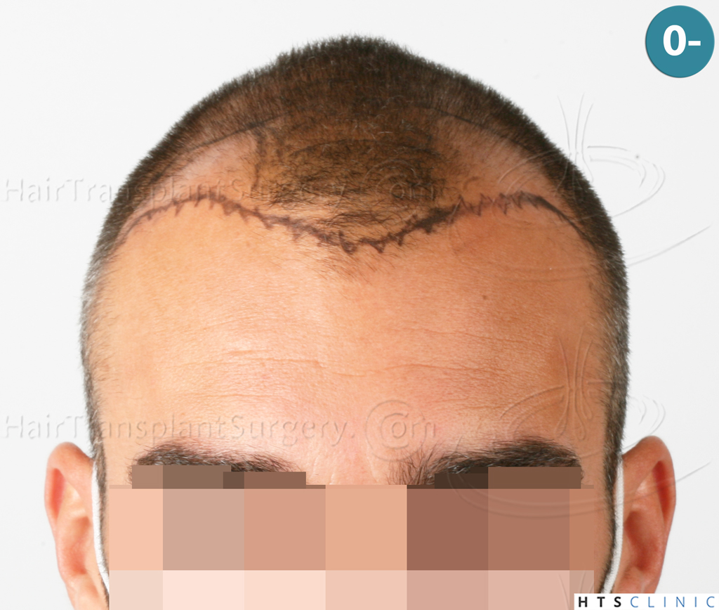 Dr.Devroye-HTS-Clinic-2258-FUE-9