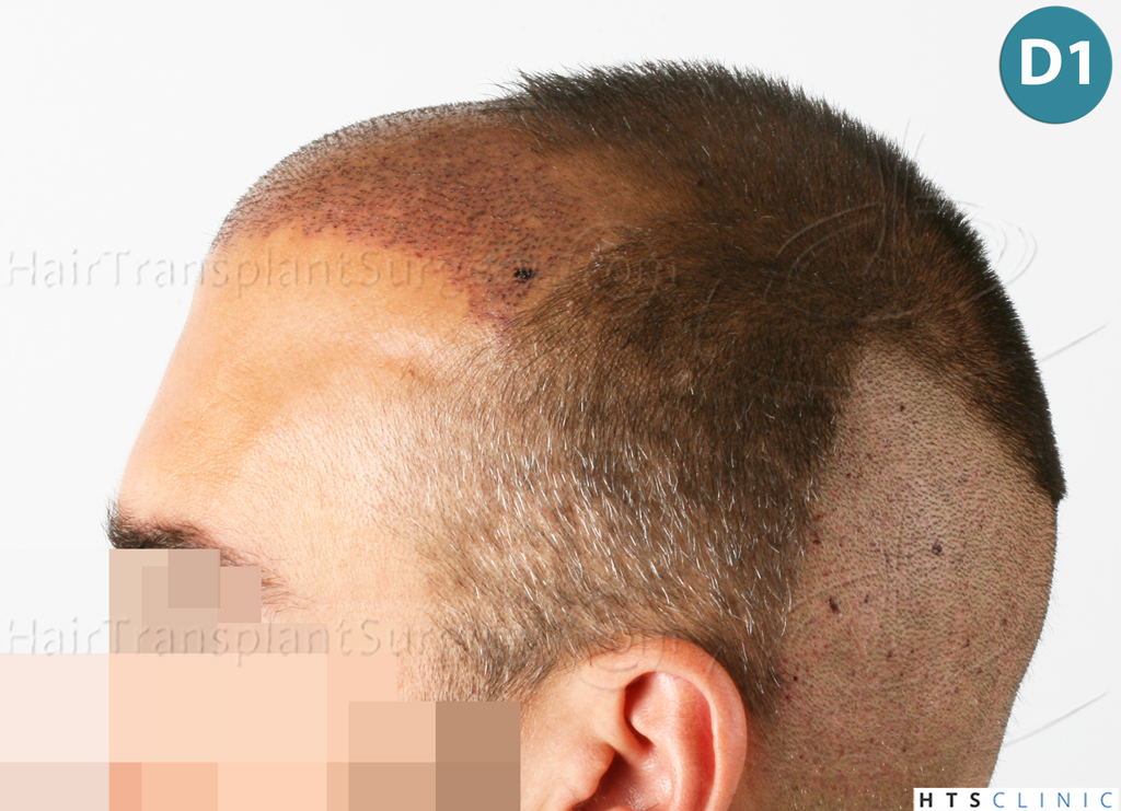 Dr.Devroye-HTS-Clinic-2258-FUE-11