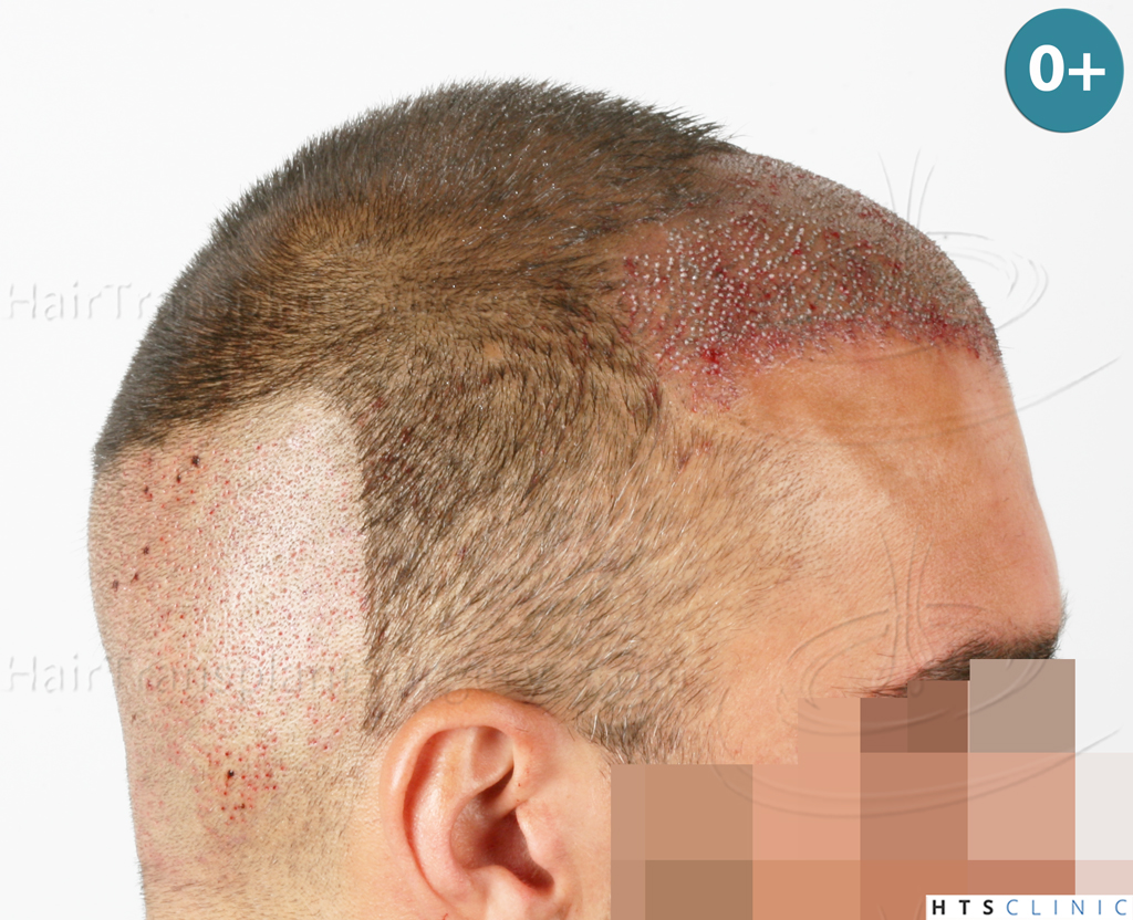 Dr.Devroye-HTS-Clinic-2258-FUE-12