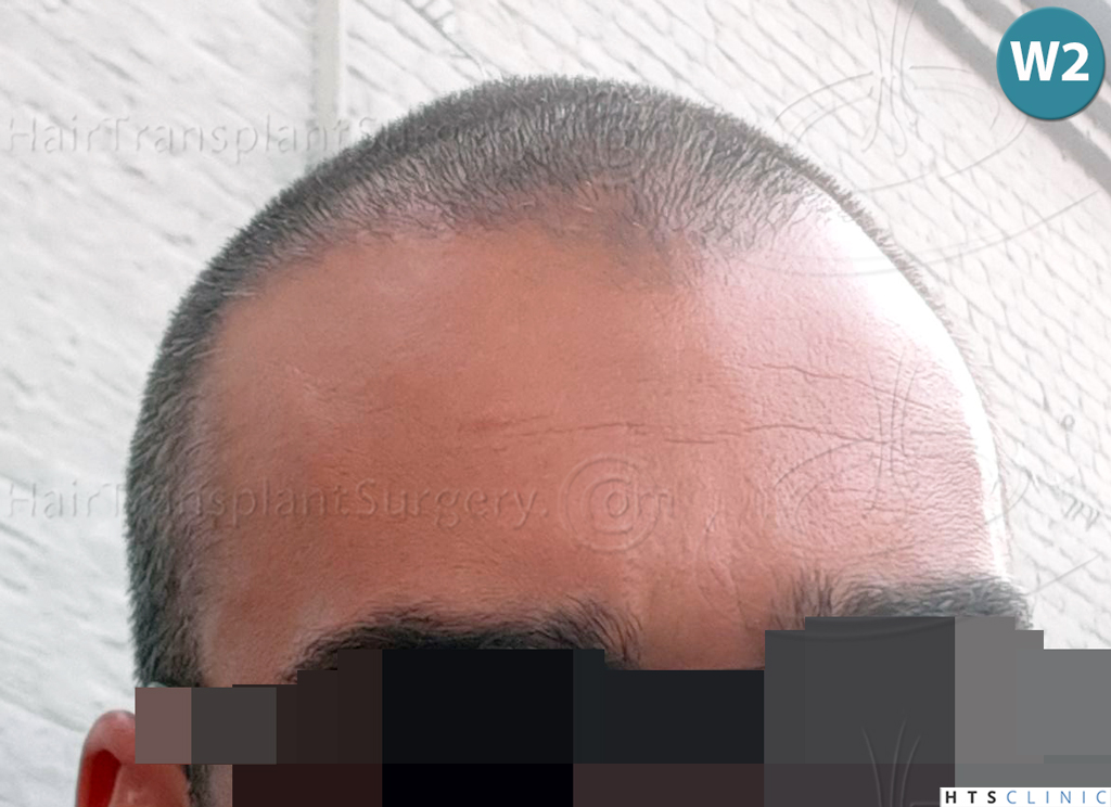 Dr.Devroye-HTS-Clinic-2258-FUE-14