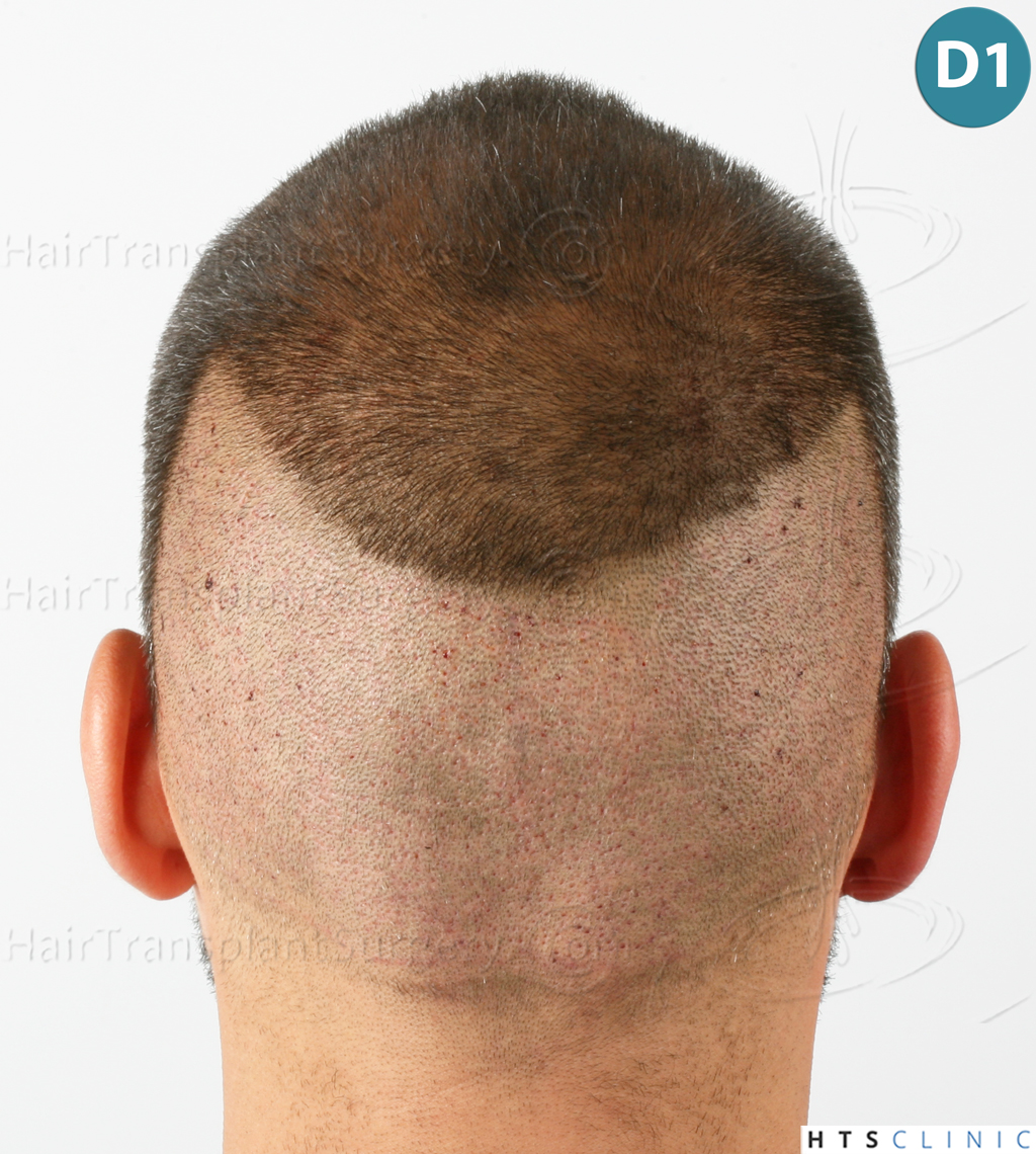 Dr.Devroye-HTS-Clinic-2258-FUE-13