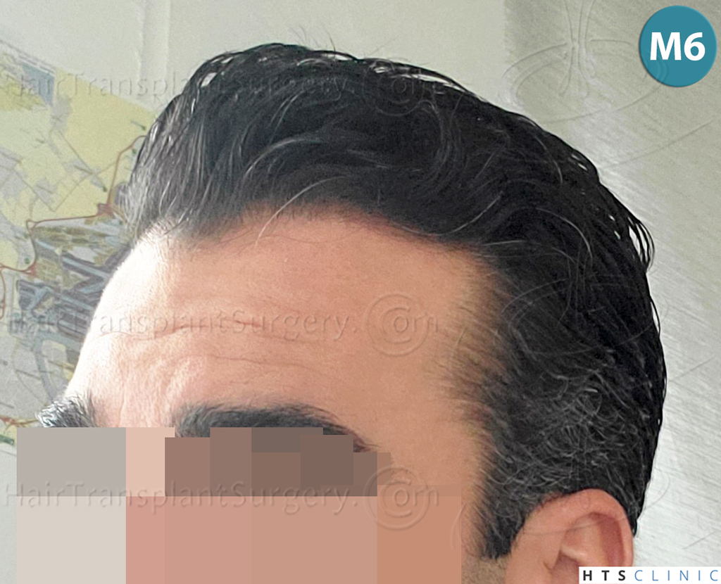 Dr.Devroye-HTS-Clinic-2258-FUE-19