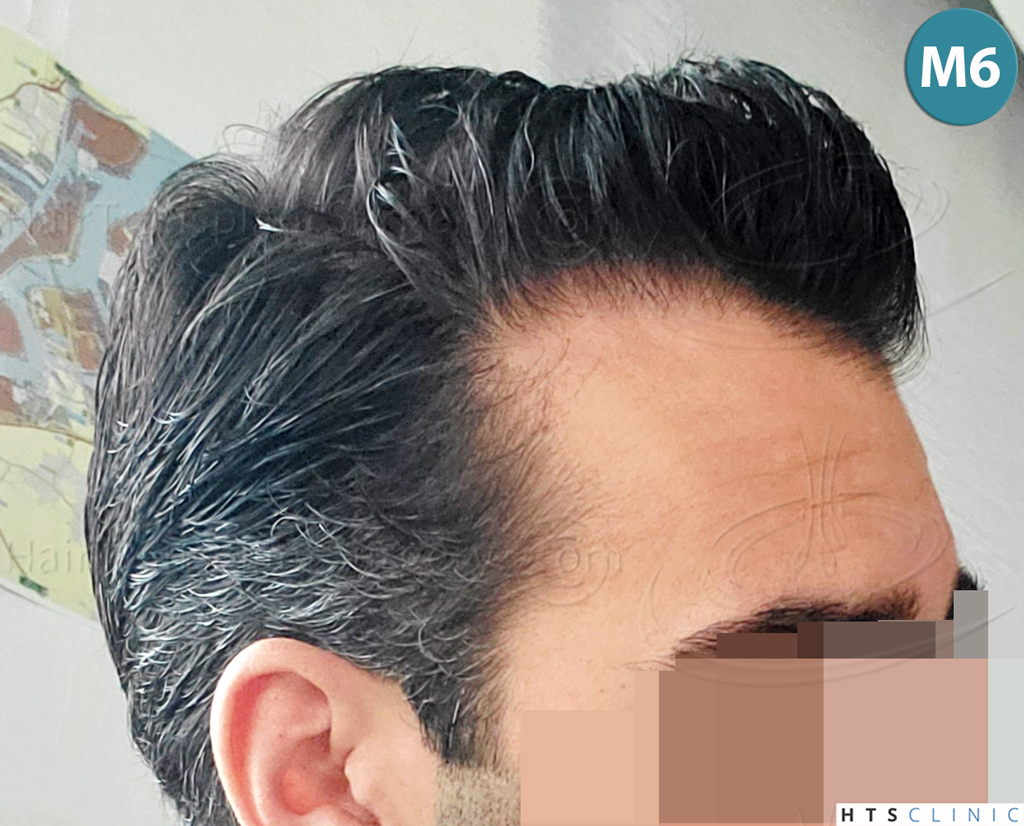 Dr.Devroye-HTS-Clinic-2258-FUE-20