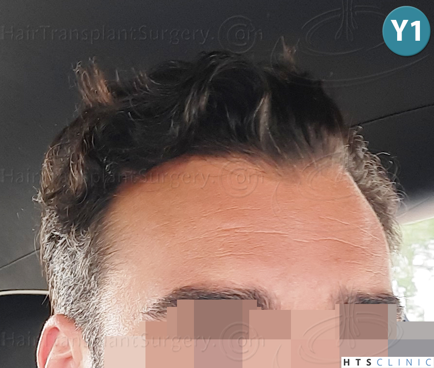 Dr.Devroye-HTS-Clinic-2258-FUE-21