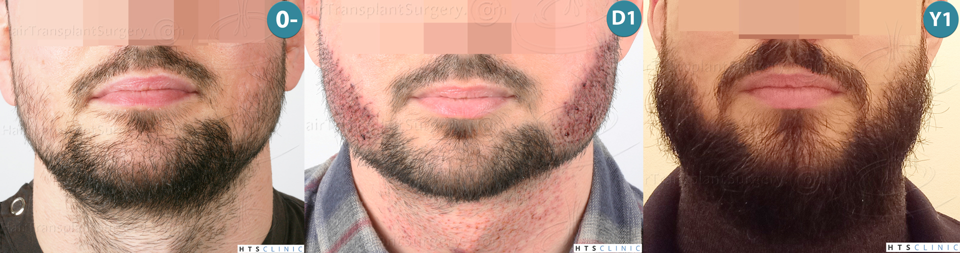 Dr.Devroye-HTS-Clinic-1523-FUE-Beard-Montage-1