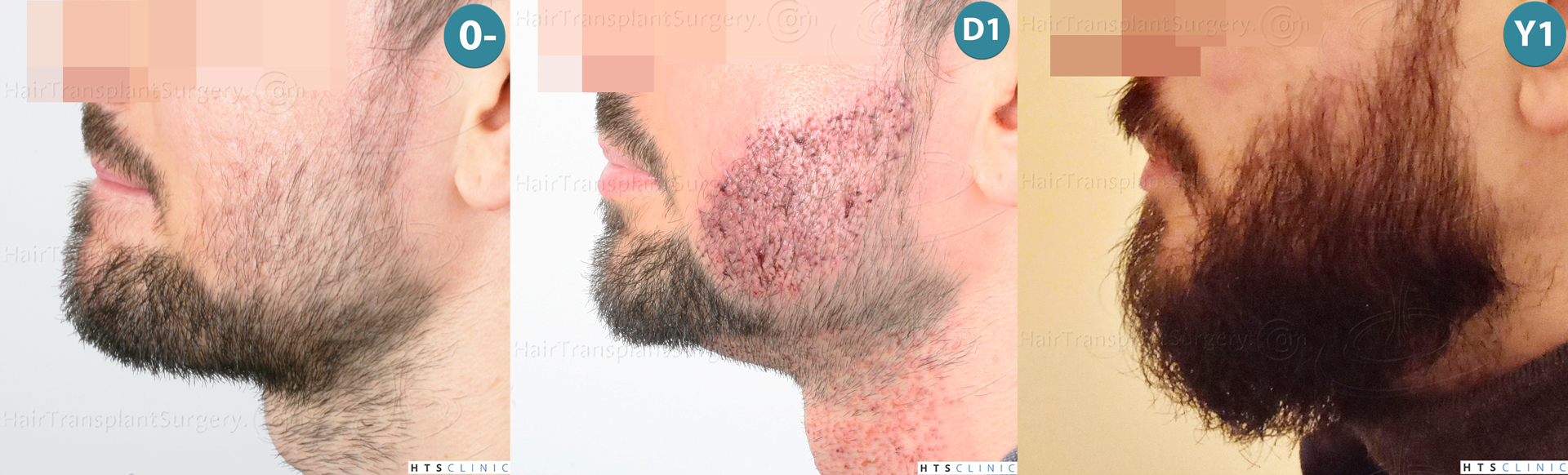 Dr.Devroye-HTS-Clinic-1523-FUE-Beard-Montage-2