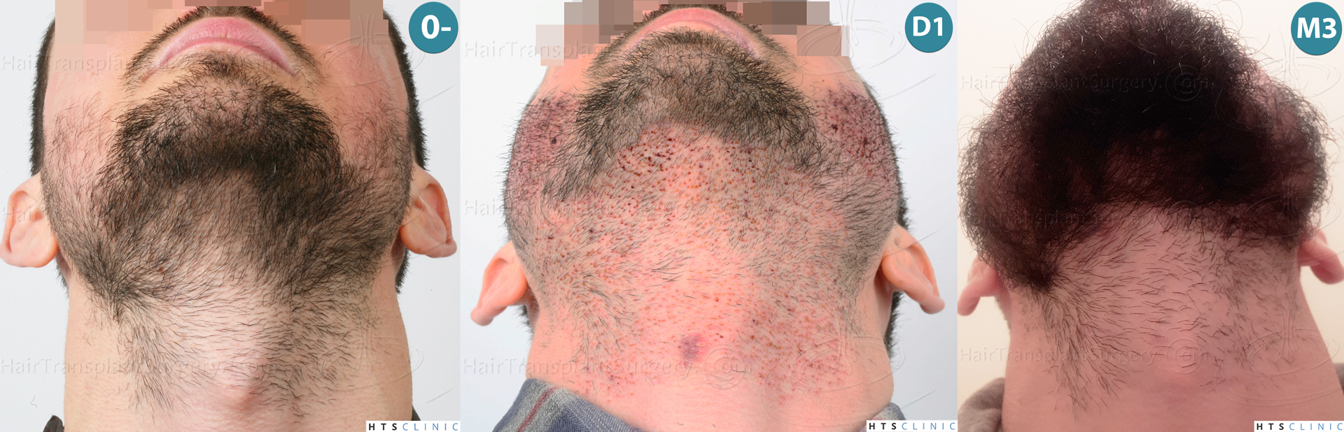 Dr.Devroye-HTS-Clinic-1523-FUE-Beard-Montage-4