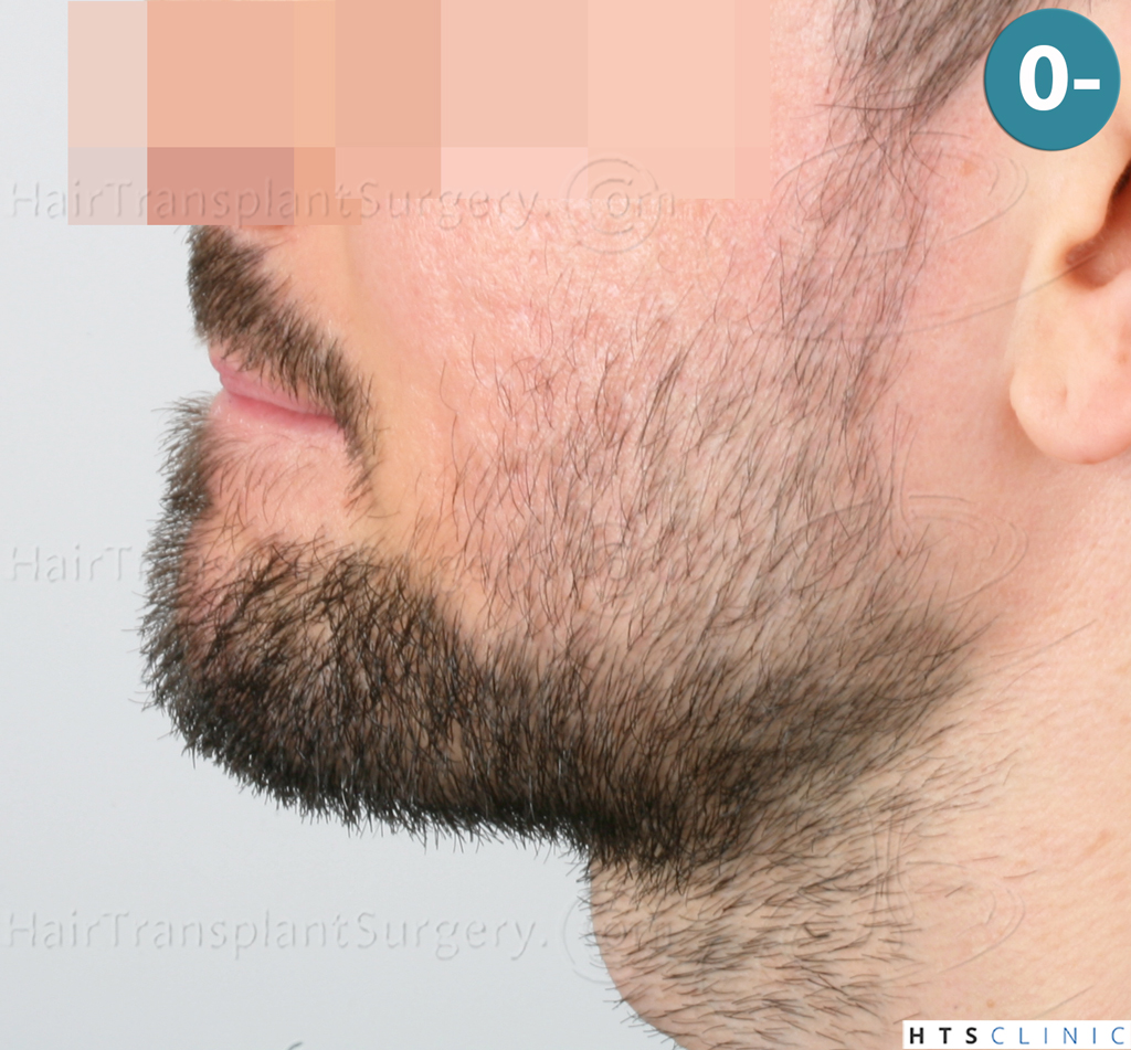 Dr.Devroye-HTS-Clinic-1523-FUE-Beard-3.j