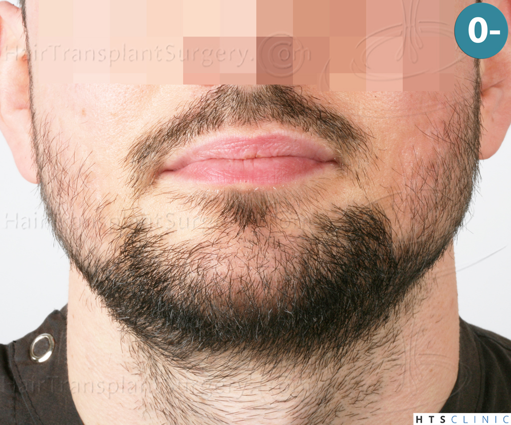 Dr.Devroye-HTS-Clinic-1523-FUE-Beard-1