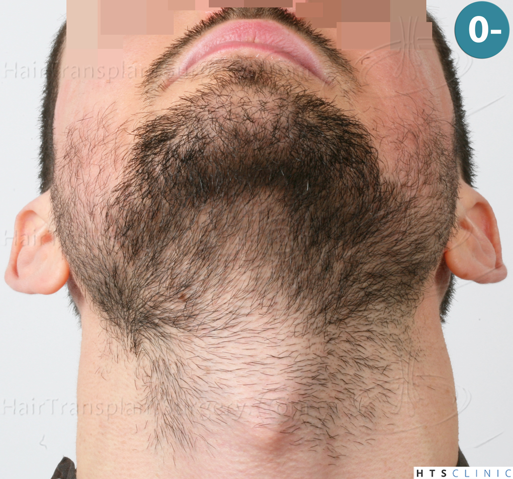 Dr.Devroye-HTS-Clinic-1523-FUE-Beard-2