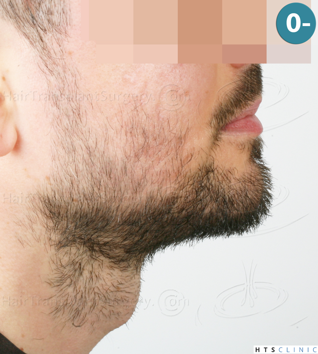 Dr.Devroye-HTS-Clinic-1523-FUE-Beard-4