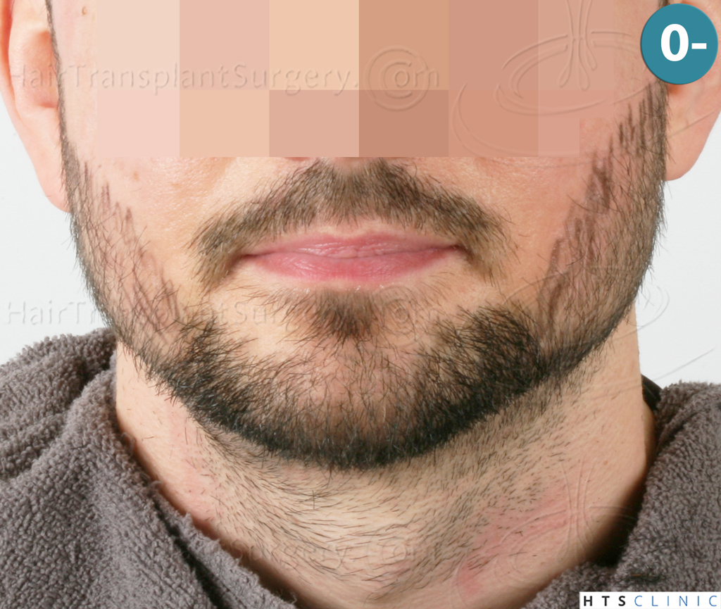 Dr.Devroye-HTS-Clinic-1523-FUE-Beard-5