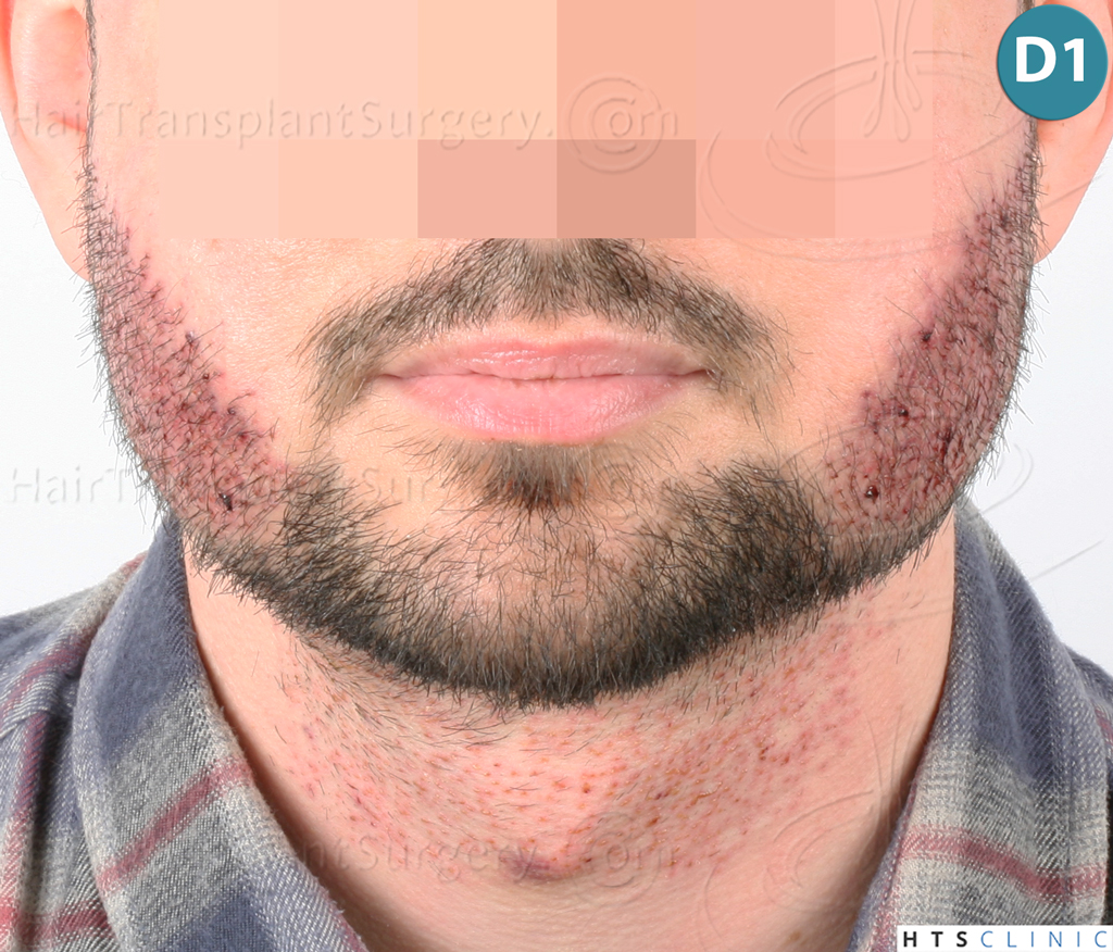 Dr.Devroye-HTS-Clinic-1523-FUE-Beard-6.j