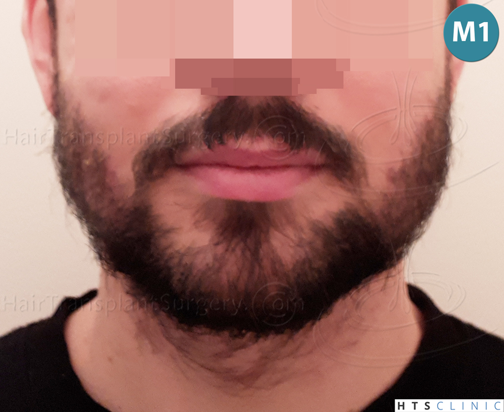 Dr.Devroye-HTS-Clinic-1523-FUE-Beard-10.