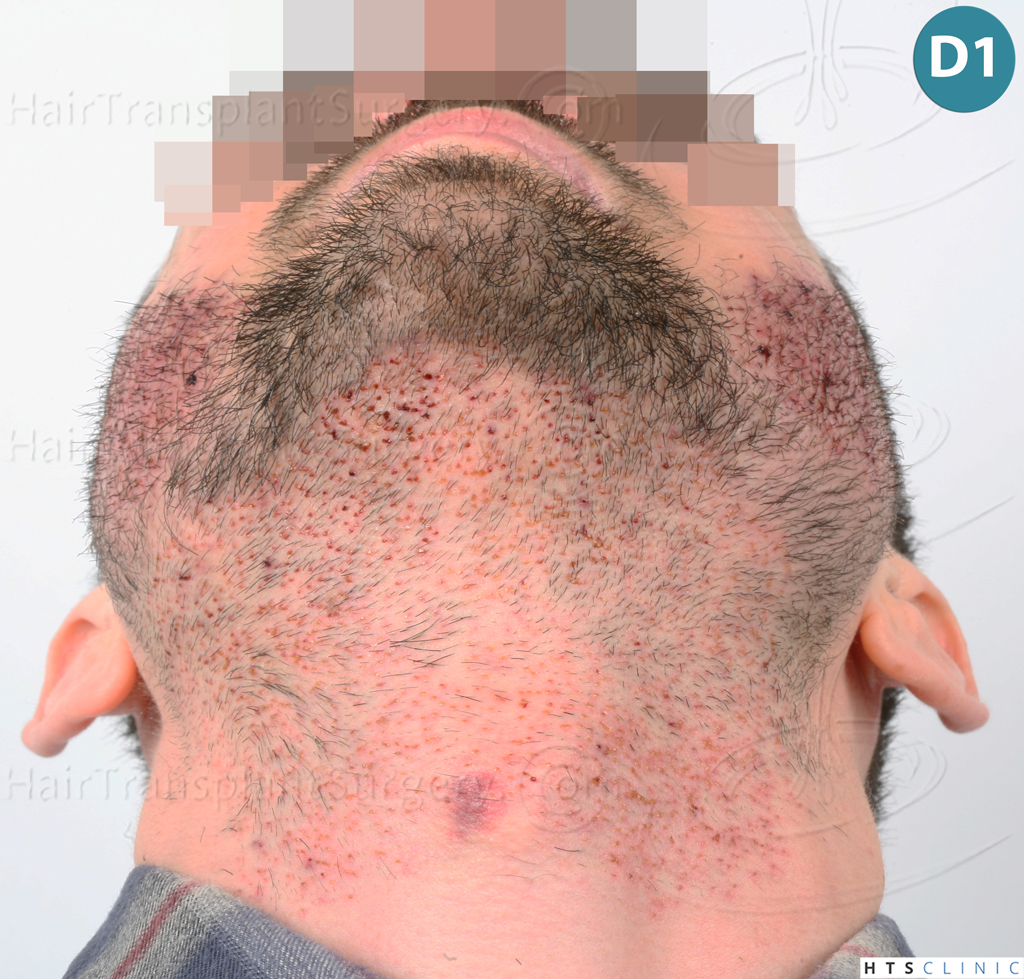 Dr.Devroye-HTS-Clinic-1523-FUE-Beard-7