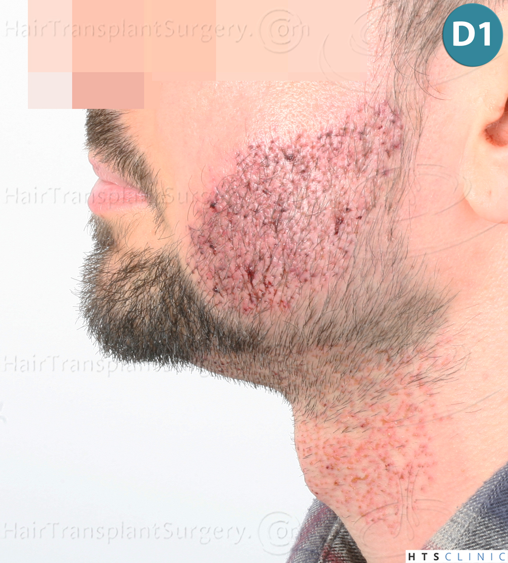 Dr.Devroye-HTS-Clinic-1523-FUE-Beard-8