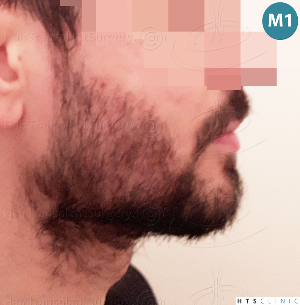 Dr.Devroye-HTS-Clinic-1523-FUE-Beard-12.