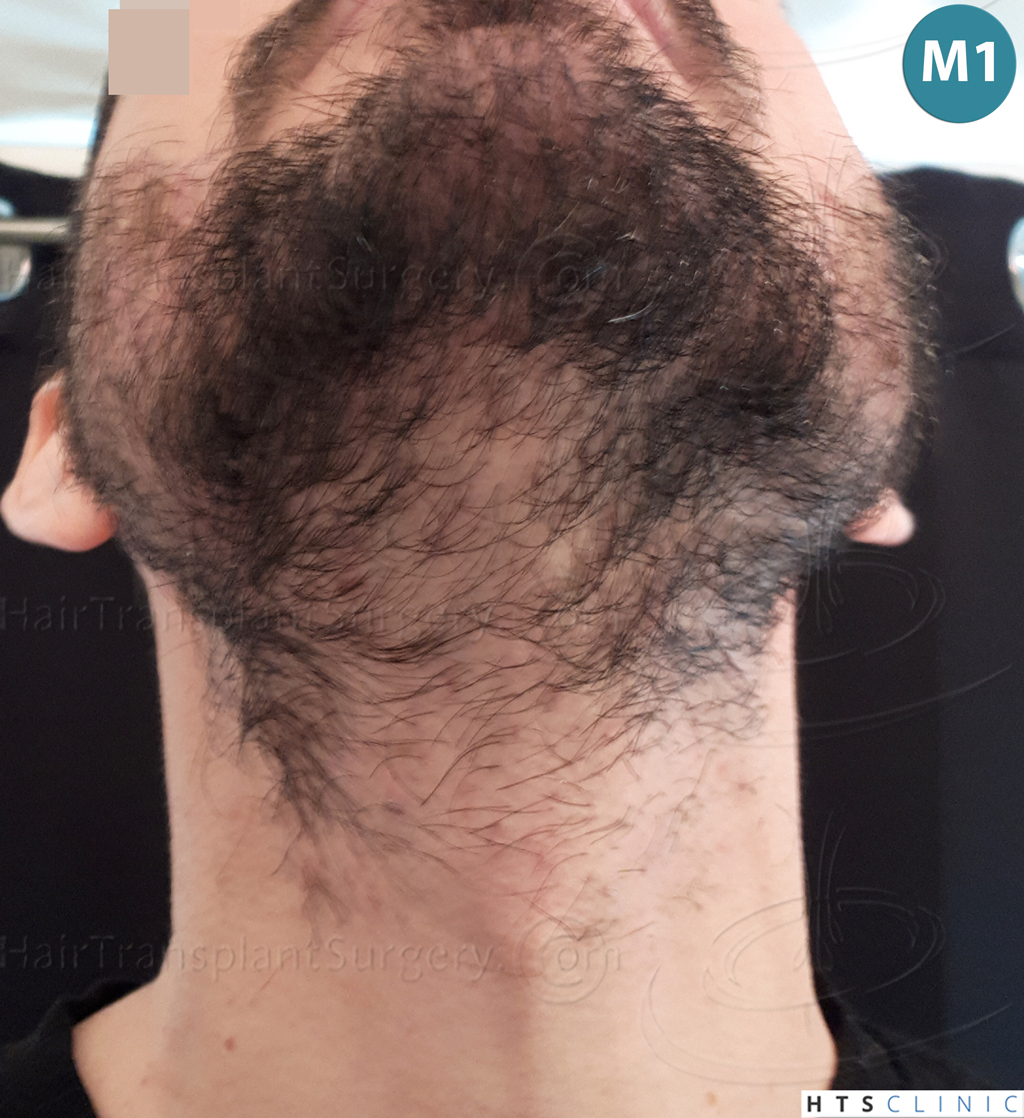 Dr.Devroye-HTS-Clinic-1523-FUE-Beard-13