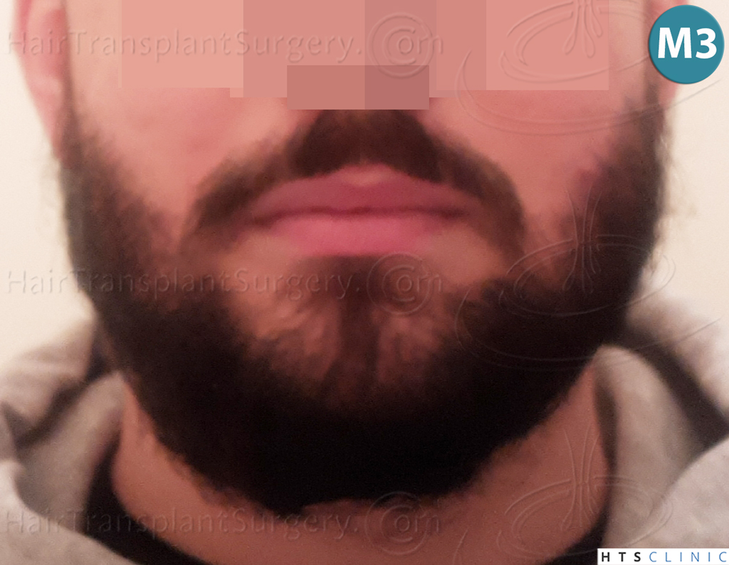 Dr.Devroye-HTS-Clinic-1523-FUE-Beard-14.