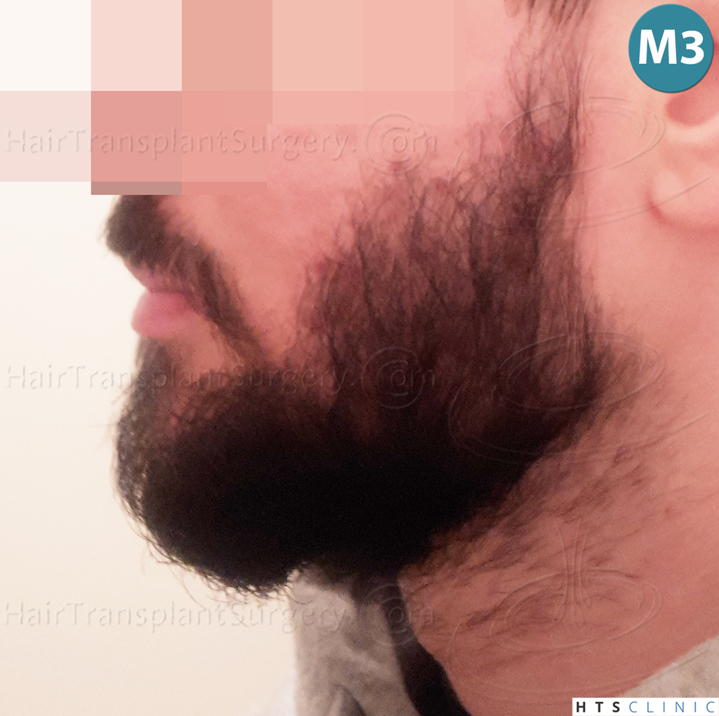 Dr.Devroye-HTS-Clinic-1523-FUE-Beard-15.