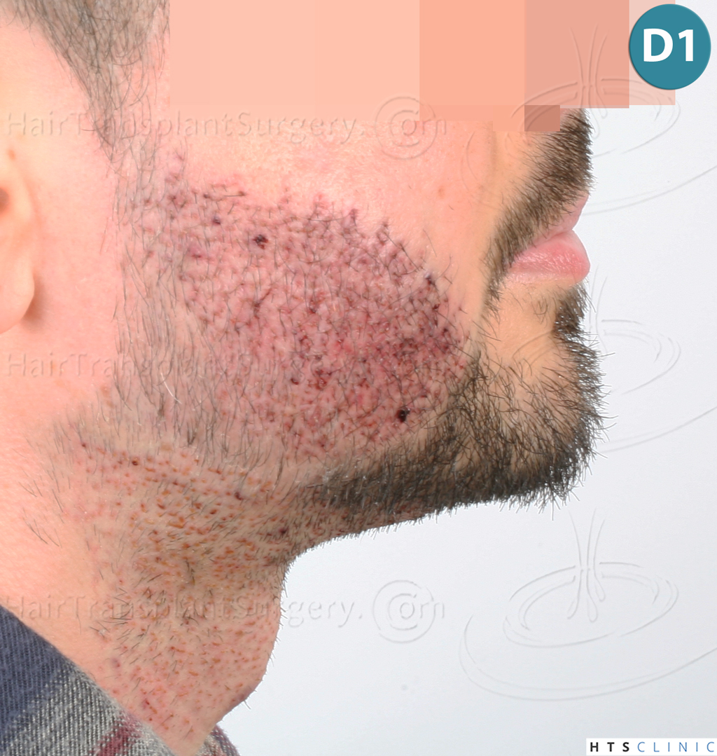 Dr.Devroye-HTS-Clinic-1523-FUE-Beard-9.j