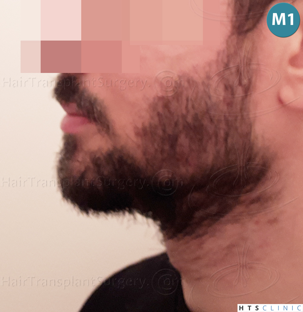 Dr.Devroye-HTS-Clinic-1523-FUE-Beard-11.