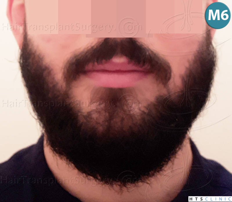 Dr.Devroye-HTS-Clinic-1523-FUE-Beard-18