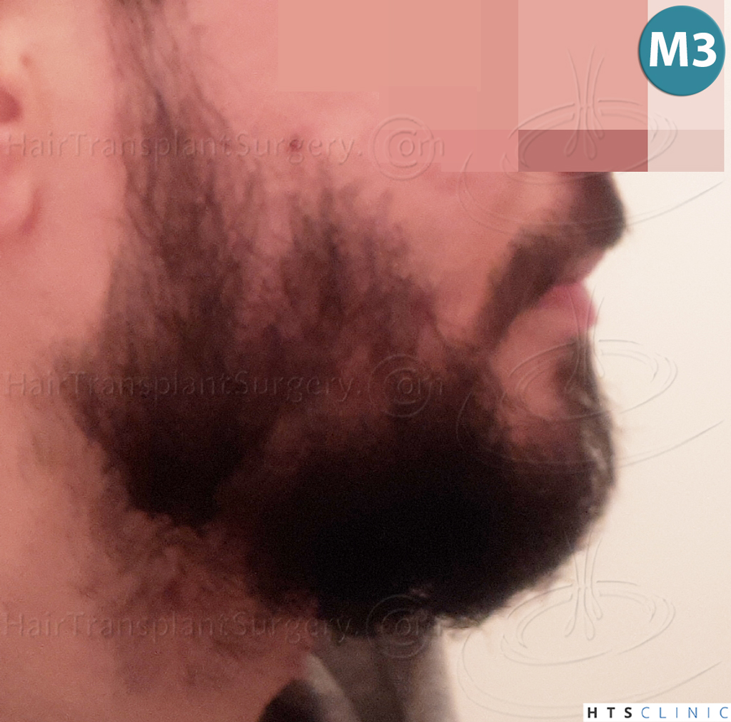 Dr.Devroye-HTS-Clinic-1523-FUE-Beard-16.