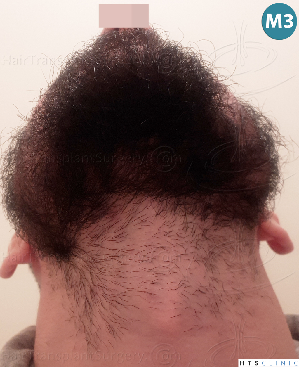 Dr.Devroye-HTS-Clinic-1523-FUE-Beard-17.