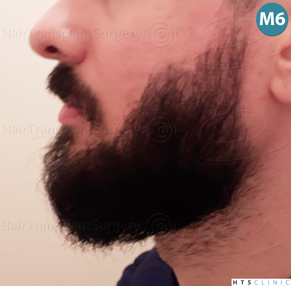 Dr.Devroye-HTS-Clinic-1523-FUE-Beard-19.