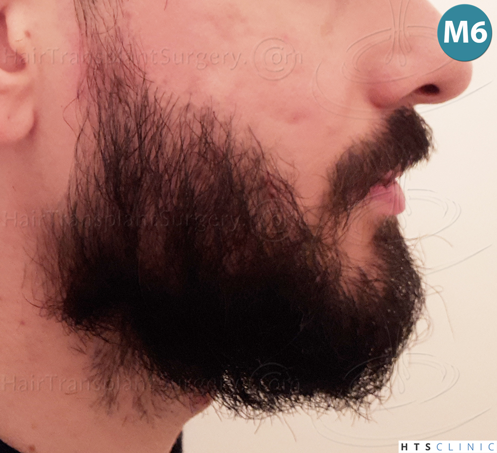 Dr.Devroye-HTS-Clinic-1523-FUE-Beard-20.