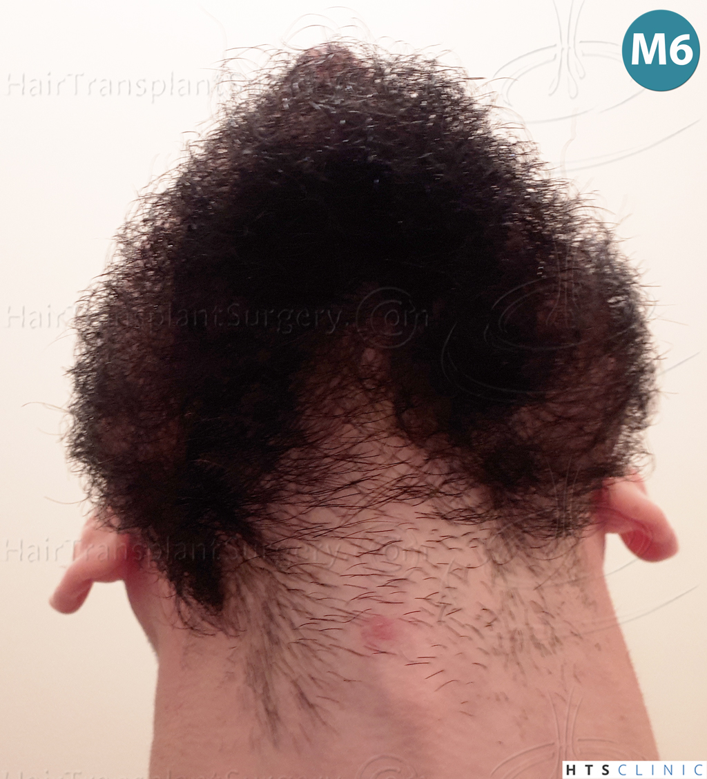 Dr.Devroye-HTS-Clinic-1523-FUE-Beard-21.