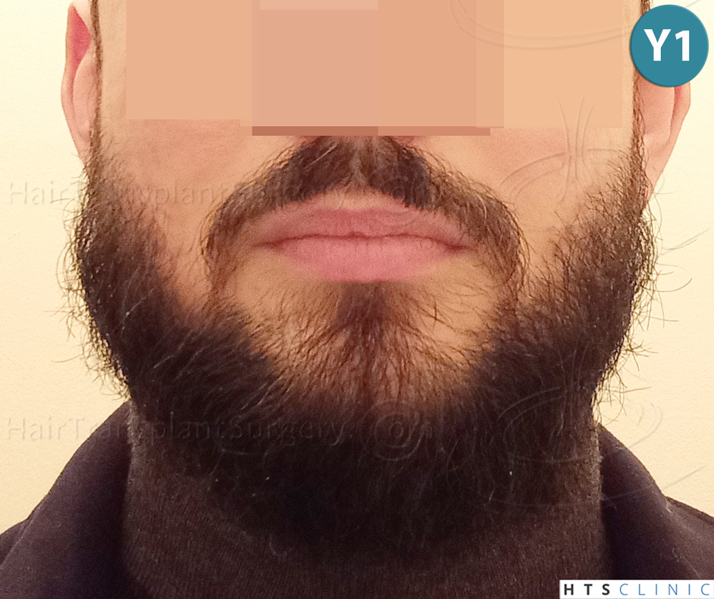 Dr.Devroye-HTS-Clinic-1523-FUE-Beard-22.