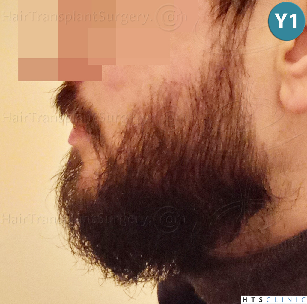 Dr.Devroye-HTS-Clinic-1523-FUE-Beard-23