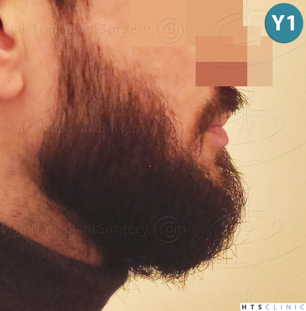 Dr.Devroye-HTS-Clinic-1523-FUE-Beard-24.