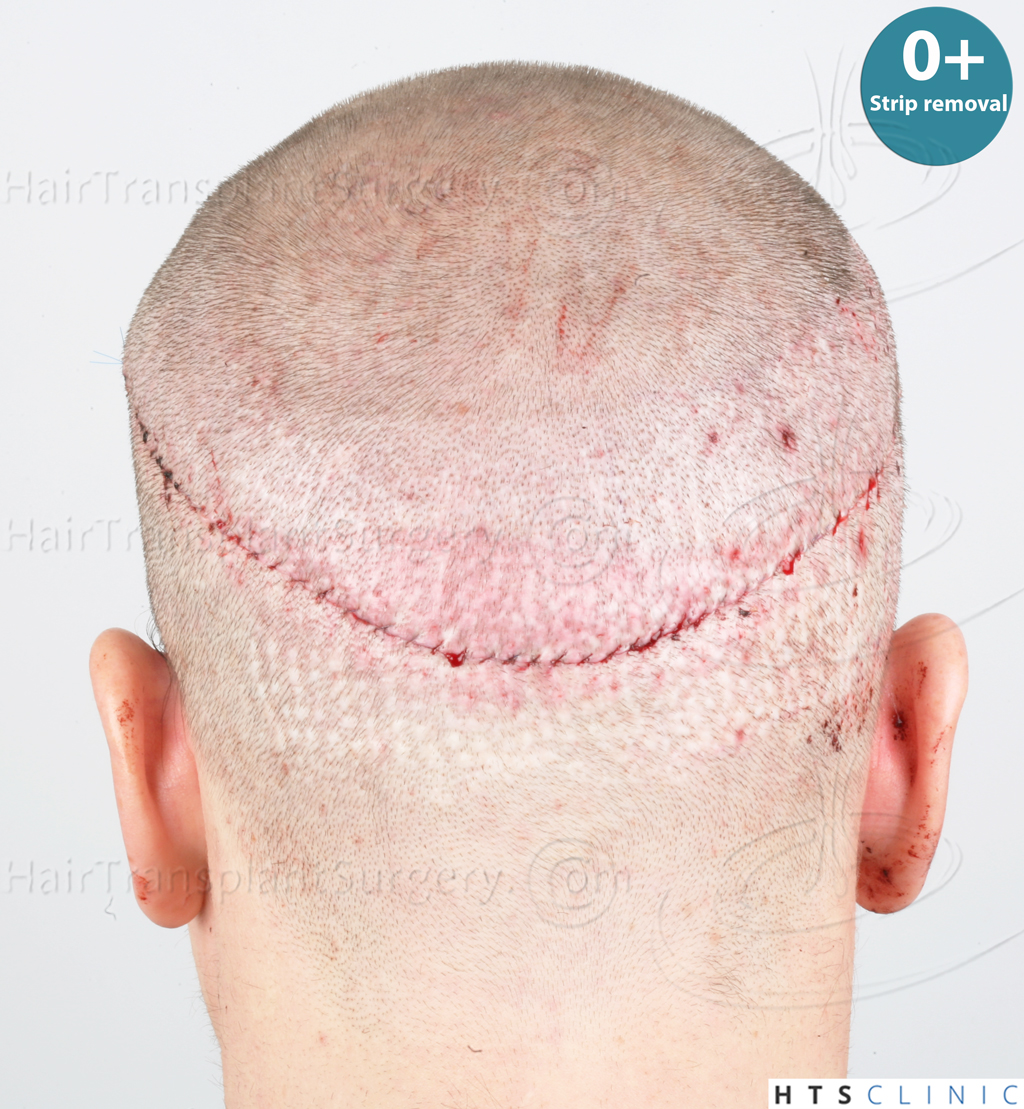 Dr.Devroye-HTS-Clinic-Grafts-Removal_3936-Combo_1479-FUE-Repair-47.jpg