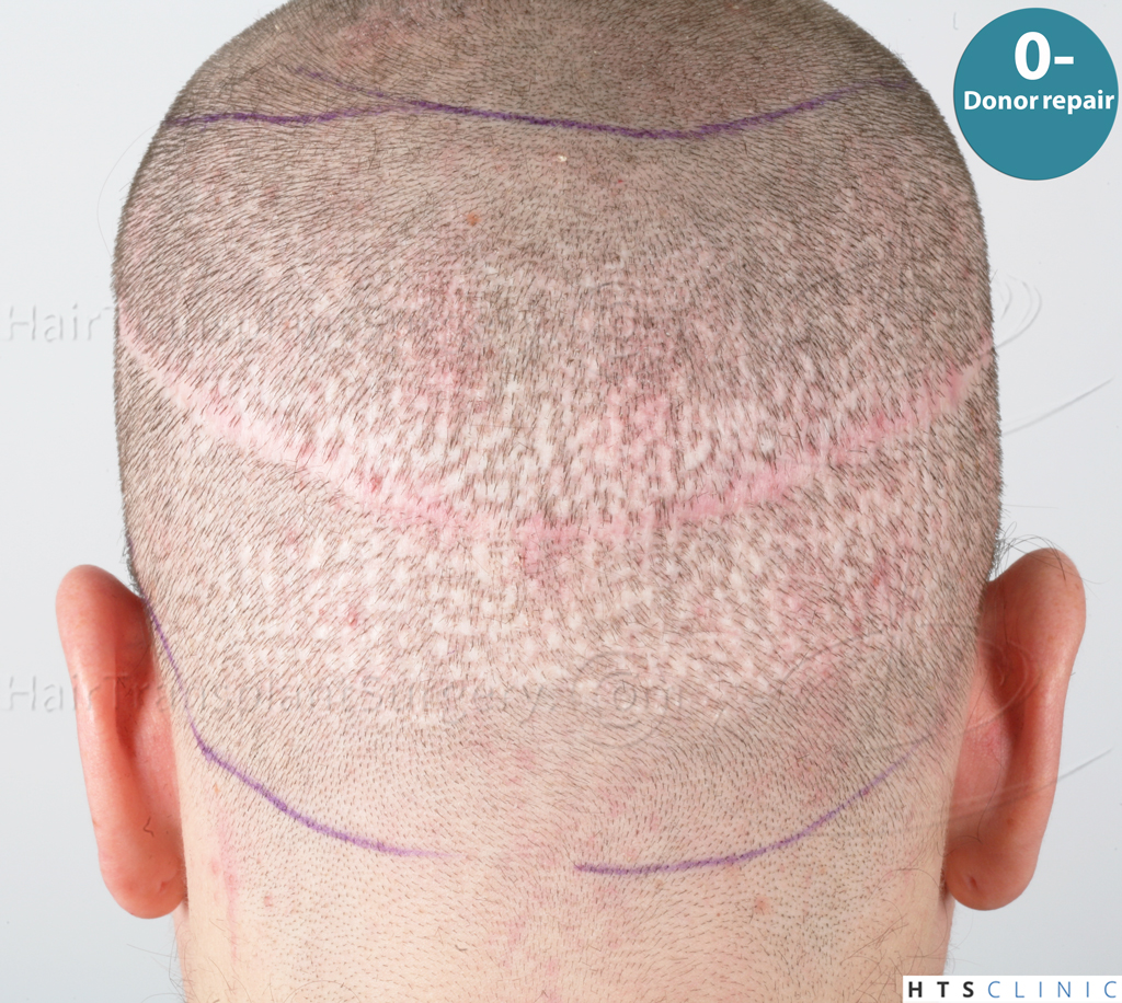 Dr.Devroye-HTS-Clinic-Grafts-Removal_3936-Combo_1479-FUE-Repair-48.jpg