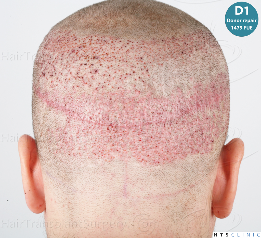 Dr.Devroye-HTS-Clinic-Grafts-Removal_3936-Combo_1479-FUE-Repair-49.jpg