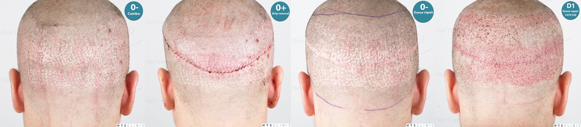 Dr.Devroye-HTS-Clinic-Grafts-Removal_3936-Combo_1479-FUE-Repair-Montage-6.jpg