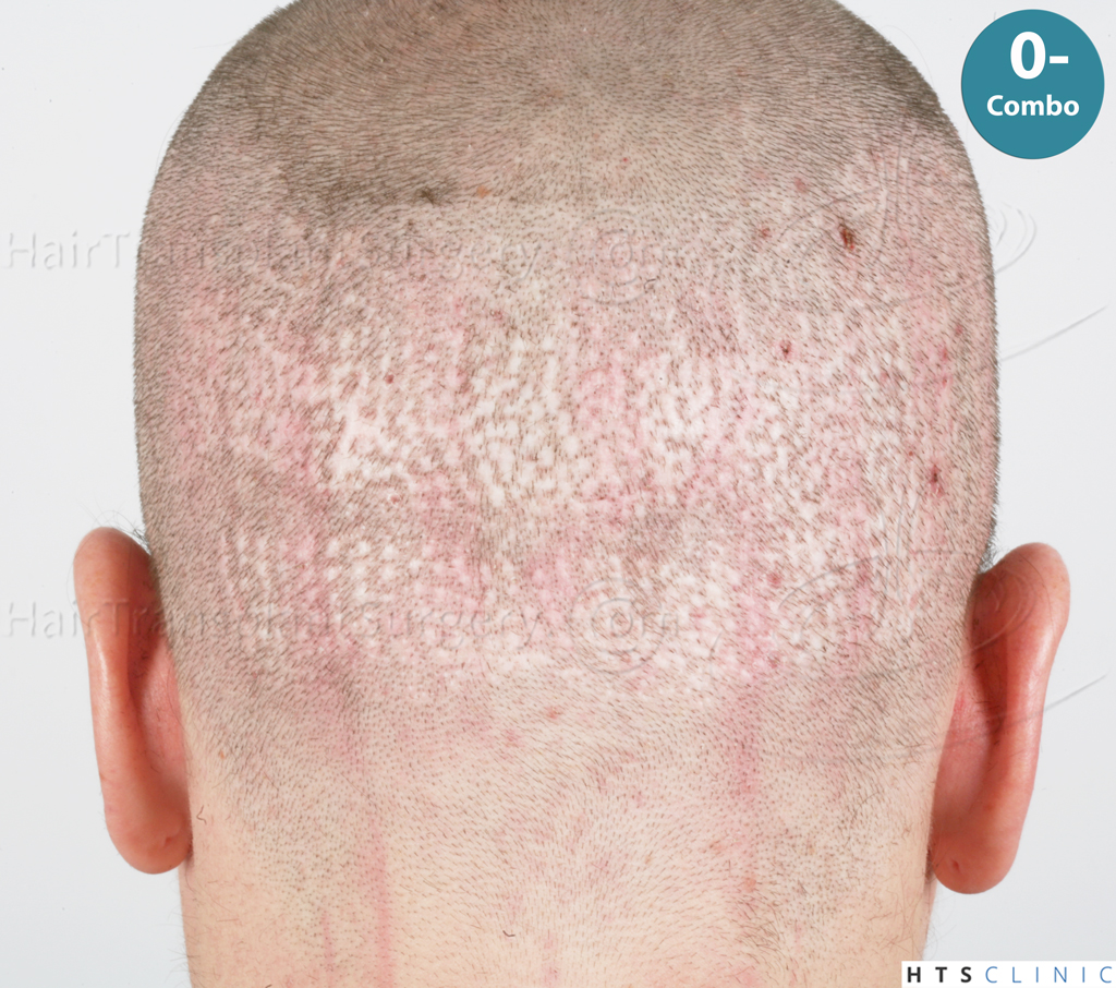 Dr.Devroye-HTS-Clinic-Grafts-Removal_3936-Combo_1479-FUE-Repair-46.jpg