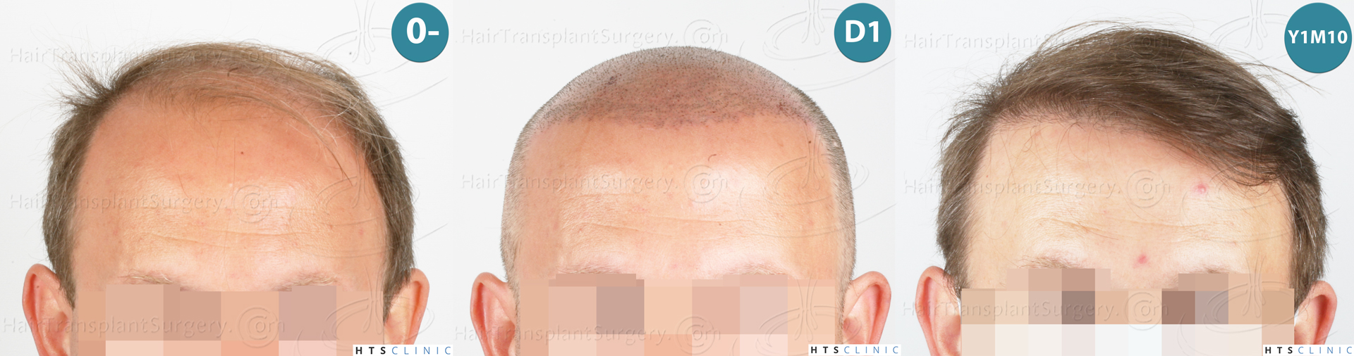 Dr.Devroye-HTS-Clinic-2238-FUE-Montage-1