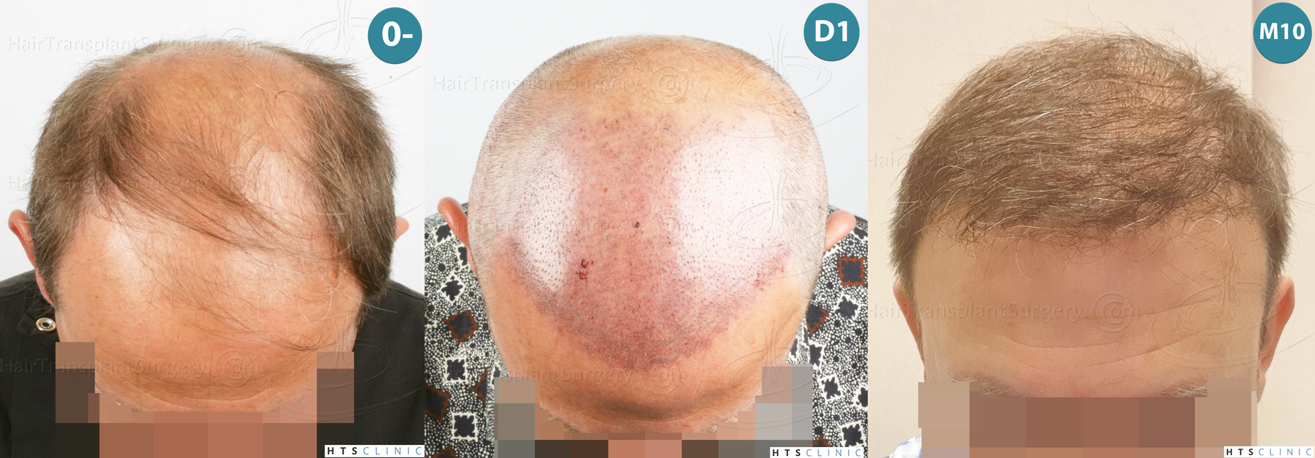 Dr.Devroye-HTS-Clinic-2238-FUE-Montage-2